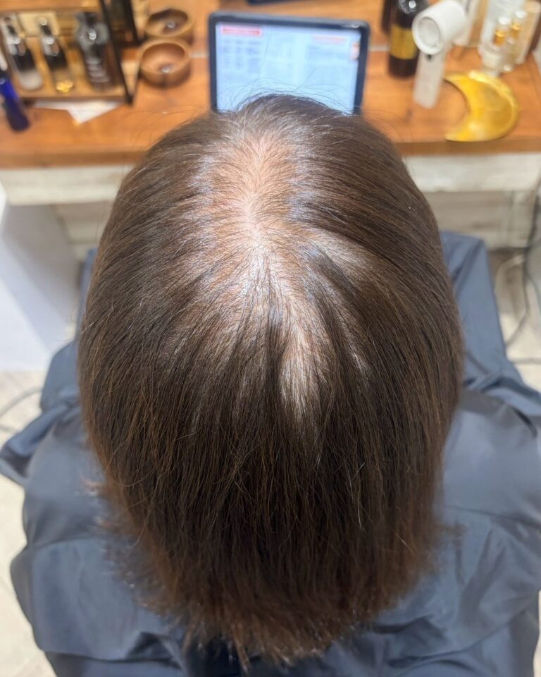 50代女性のトップピース装着前。上から見た分け目と頭頂部